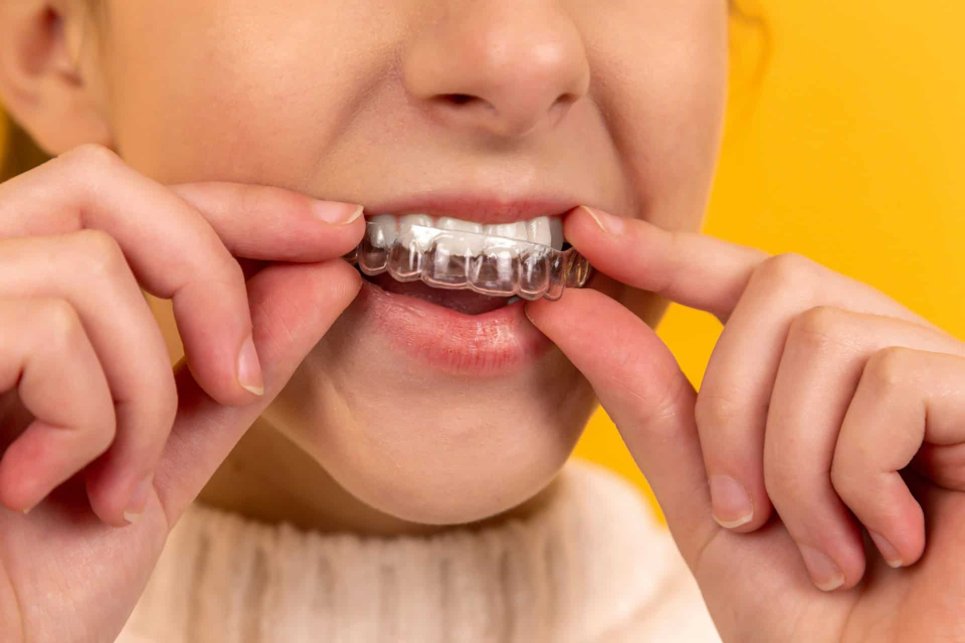teeth aligners