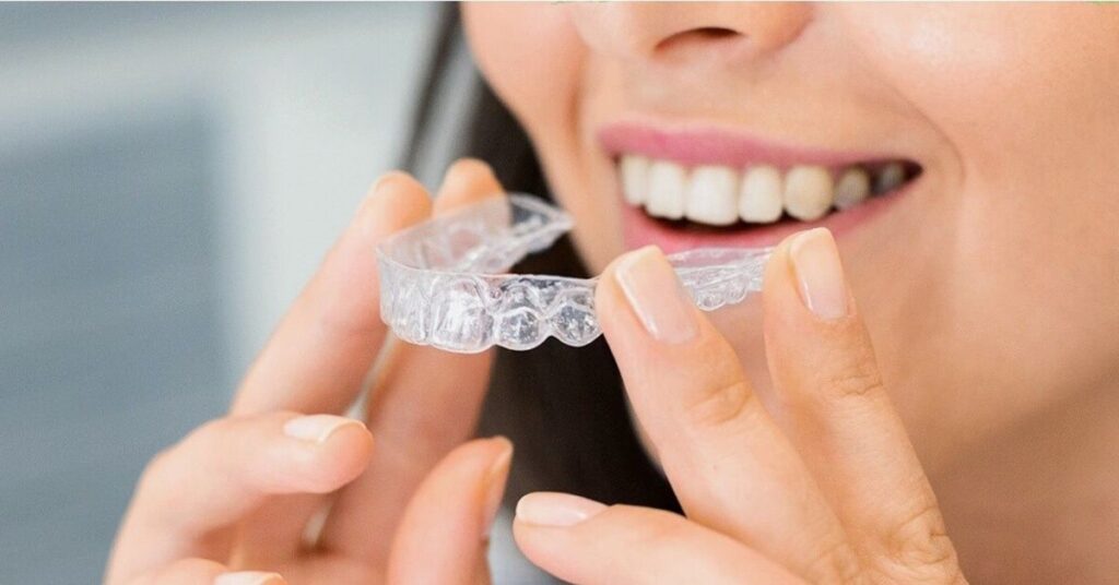 What Are Teeth Aligners? 1 Teeth Aligners 1
