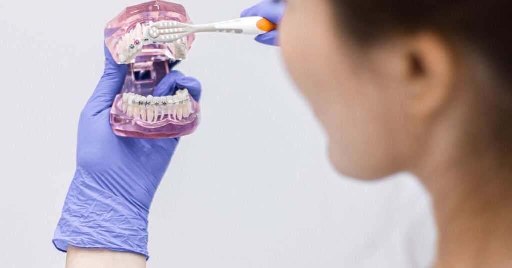 What Is the Role of Spacers in Braces? 1 Braces 10