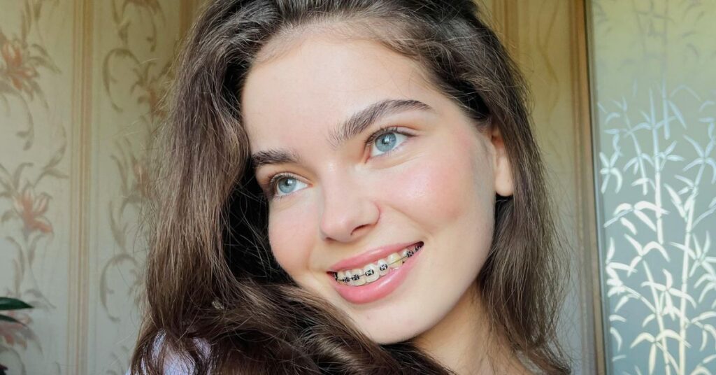 Why Are Wires and Bands Important in Braces? 1 Braces 2 1