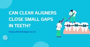 Clear Aligners