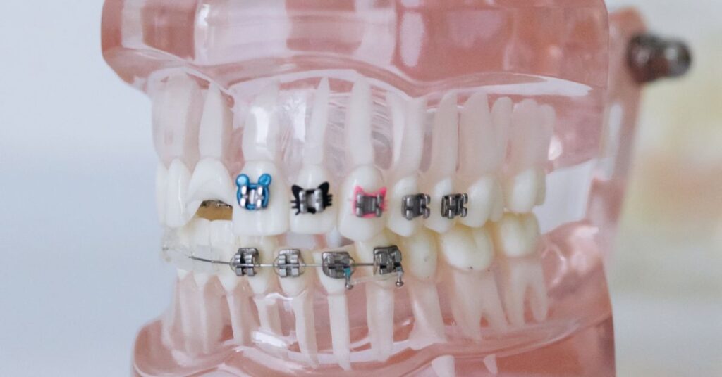 Are Clear Aligners Safe for People with Gum Issues? 1 Clear Aligners 9