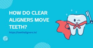 Clear Aligners