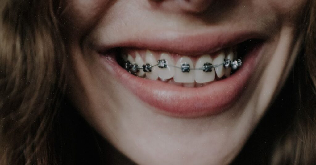 How Do Braces Work Differently for Kids vs. Adults? 1 Braces 14