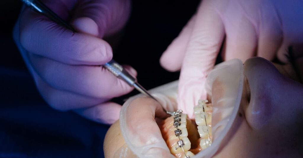 How Do Braces Move Teeth Safely? 1 Braces 20