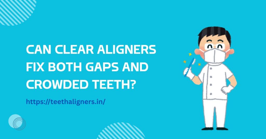 Clear Aligners