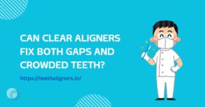 Clear Aligners