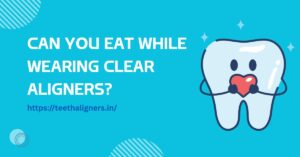 Clear Aligners